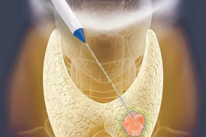 Radiofrequency ablation procedure for thyroid nodules