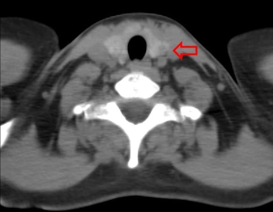 CT scan image showing thyroid mass